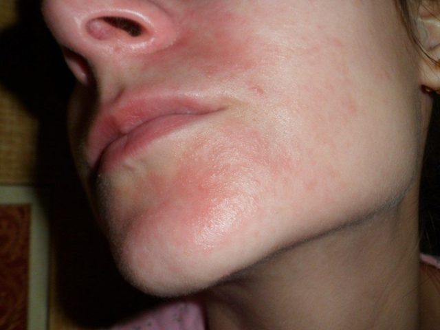 Аллергический дерматит на лице: лечение, фото и симптомы