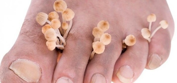 Почему чернеют ногти на ногах и руках - как лечить
