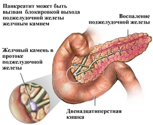 Аюрведа: поджелудочная железа и лечение панкреатита, согласно учению