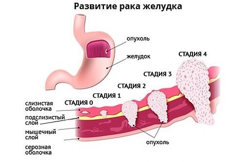 Рак желудка: первые симптомы и поздние признаки, лечение и прогноз