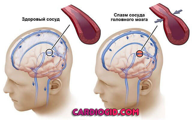 Нарушение венозного оттока крови головного мозга: симптомы и лечение дисциркуляции