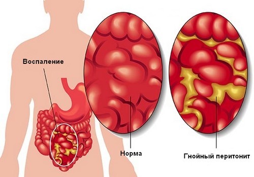 Гнойный перитонит – виды, причины, симптомы и лечение