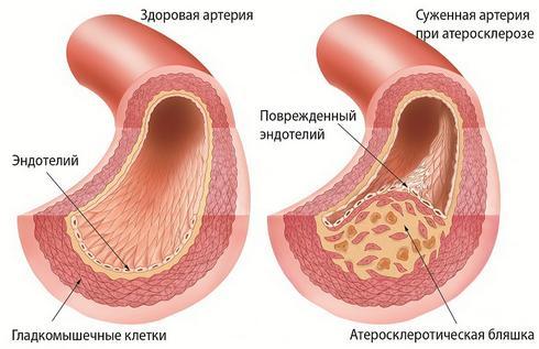 Немеет левая нога: причины и лечение недуга