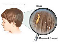 Педикулез у детей - причины, симптомы, диагностика и лечение