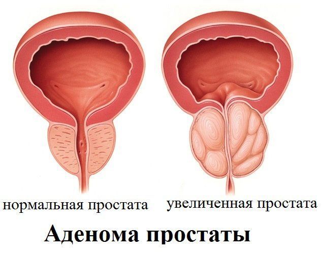 Затрудненное мочеиспускание у мужчин - причины и лечение