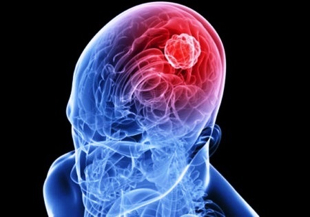 Ретроцеребеллярная арахноидальная киста головного мозга: размеры и лечение