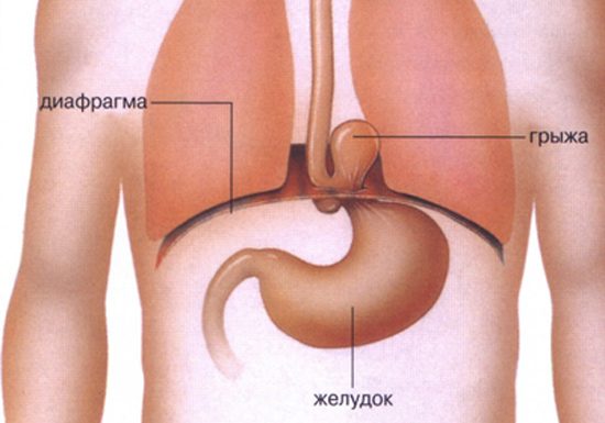 Диафрагмальная грыжа у детей: причины, симптомы, диагностика, лечение