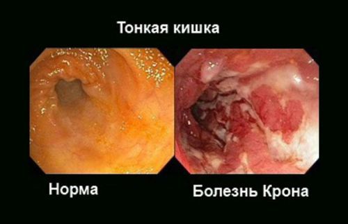 Болит низ живота справа у женщины, что это может быть, как лечить, если ноет, отдает в ногу, причины