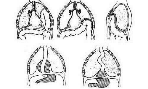 Диафрагмальная грыжа у детей: причины, симптомы, диагностика, лечение