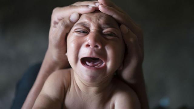Краниосиностоз у детей – причины развития и чем опасна патология