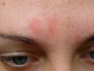 Красные пятна на лице у женщин и мужчин: причины «горящих щек» и методы лечения