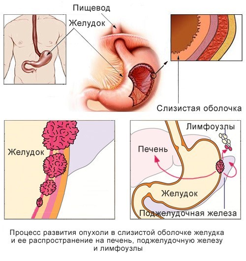 Рак желудка: первые симптомы и поздние признаки, лечение и прогноз