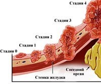 Рак желудка: первые симптомы и поздние признаки, лечение и прогноз