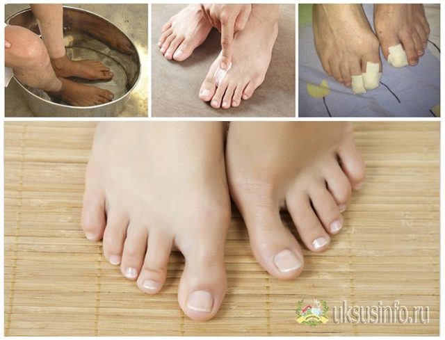 Лечение грибка ногтей уксусом на ногах, руках: эффективные рецепты, отзывы