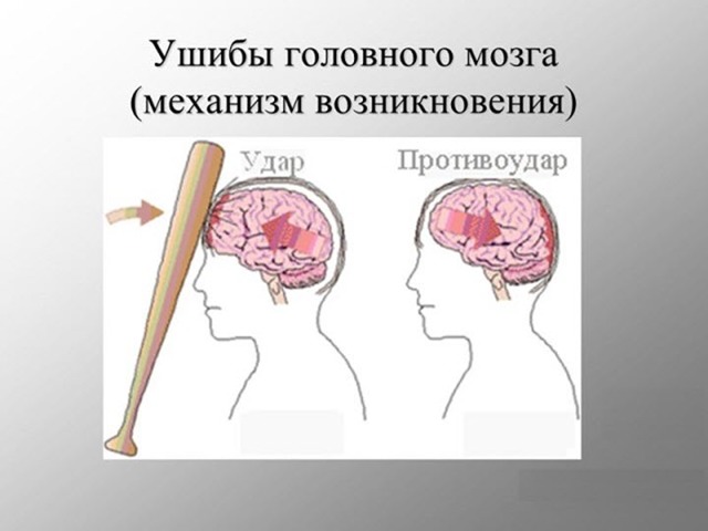 Ушиб головного мозга: причины, симптомы, степени, лечение