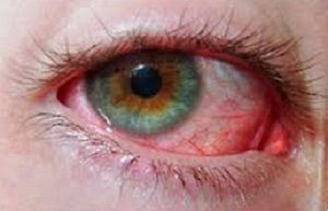Болят глазные яблоки: почему возникают такие ощущения и о чем это говорит?