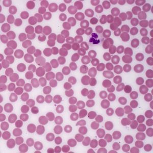 Диагностика панкреатита - анализ крови на липазу и амилазу