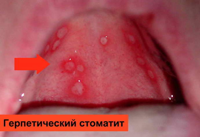 На языке белые язвочки у взрослого: возможные причины, как лечить