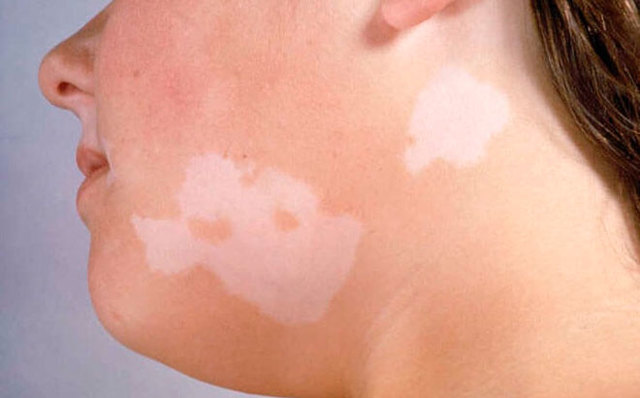 Появились белые пятна на лице у ребенка и на коже: причины и фото