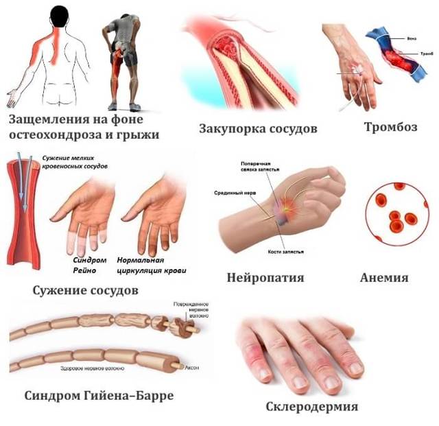 Почему одновременно немеет левая рука и левая нога — как лечить онемение?