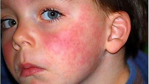 Аллергический дерматит на лице: лечение, фото и симптомы