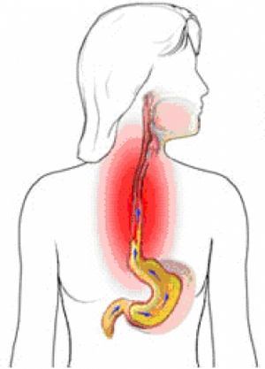 Боль в пищеводе и в груди при глотании - отдает в спину