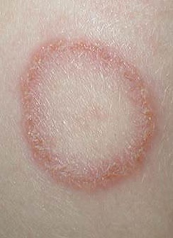 Микроспория гладкой кожи: симптомы, диагностика и лечение