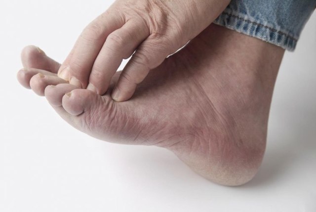 Что такое грибок ногтей на ногах - как выглядит и виды заболевания, симптомы и средства терапии