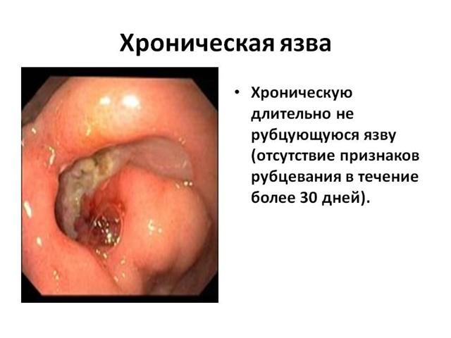 Лечение язвы желудка и двенадцатиперстной кишки медикаментами