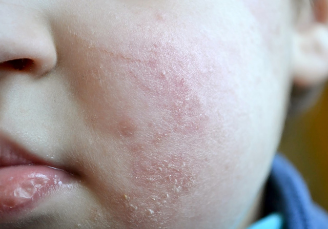 Красные щеки у ребенка и взрослого - симптом гиперемии, аутоиммунных болезней, гипертонии и аллергии