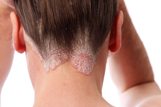 Раздражение кожи головы - лечение и причины.