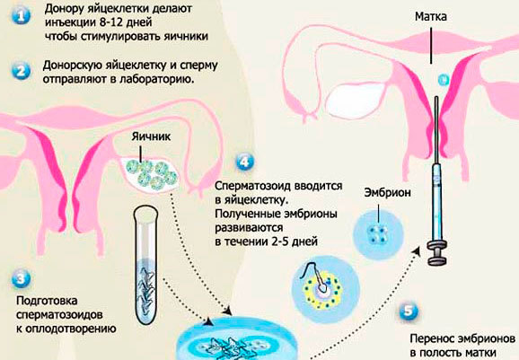 Пункция фолликулов (яйцеклеток) при ЭКО: забор яйцеклеток, диета до и после