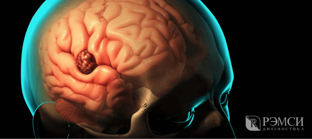 Первые признаки рака головного мозга: как определить патологию