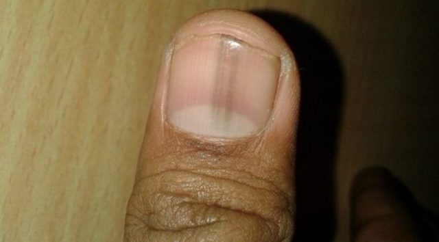 Черные полоски на ногтях рук: причины, что это значит, как лечить