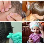 Вши у ребенка на голове: фото, внешний вид и описание симптомов