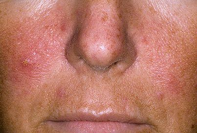 Псориаз на лице - как проявляется и чем его лечить?