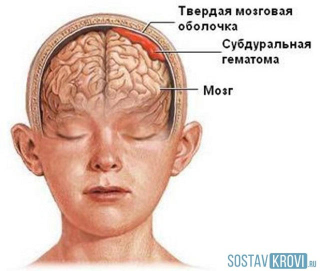 Ушиб головного мозга: причины, симптомы, степени, лечение