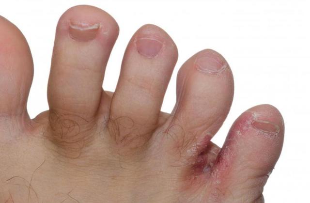 Грибок между пальцами ног - чем лечить?