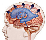 Гидроцефалия головного мозга у взрослых - причины, симптомы, лечение