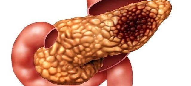 Диффузные изменения поджелудочной железы по типу липоматоза, панкреатита, при фиброзе – что это такое?