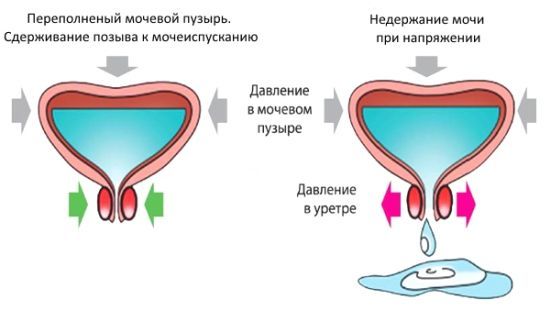 Катетеризация мочевого пузыря у мужчин и женщин: показания противопоказания к процедуре и виды катетеров