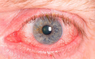 Красные глаза после наращивания ресниц: почему они такие и болит внизу один или оба, нормально ли это, что делать, как убрать, через сколько пройдет, каково лечение?