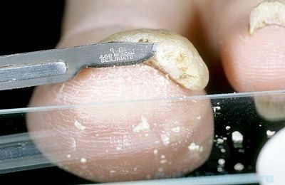 Как готовиться к соскобу на грибок кожи и ногтей, где сдать