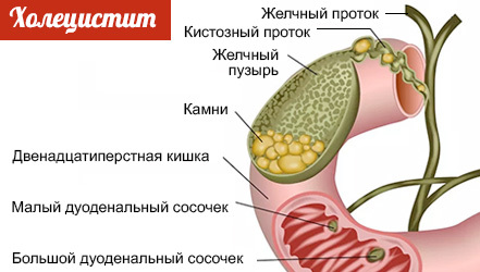 Холецистит картинки для буклета