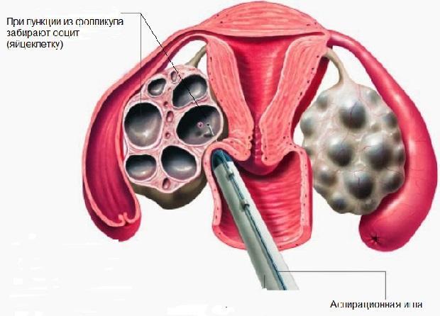 Пункция фолликулов (яйцеклеток) при ЭКО: забор яйцеклеток, диета до и после
