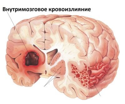 Киста у новорожденного в голове опасна ли? Причины и последствия