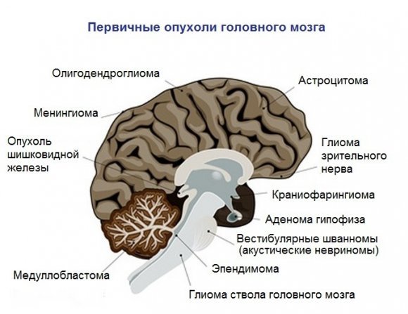 Чем вызвана менингиома головного мозга - причины, симптомы, лечение