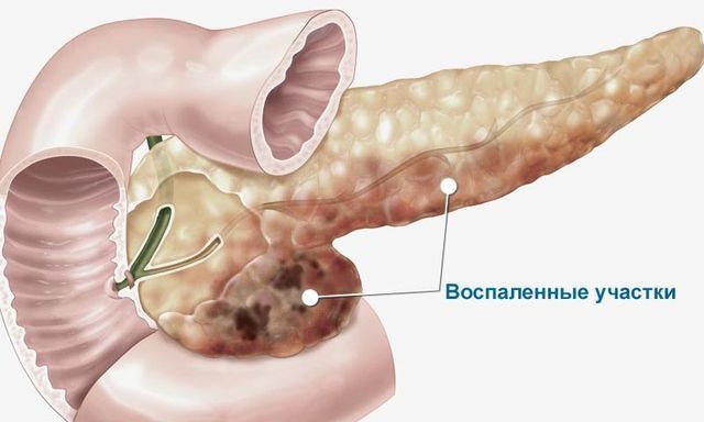 Диффузные изменения поджелудочной железы лечение