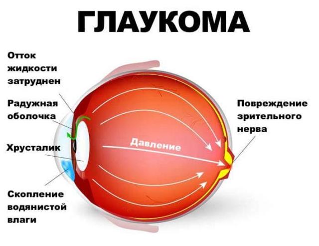 Лучшие глазные капли от глаукомы: список самых эффективных средств