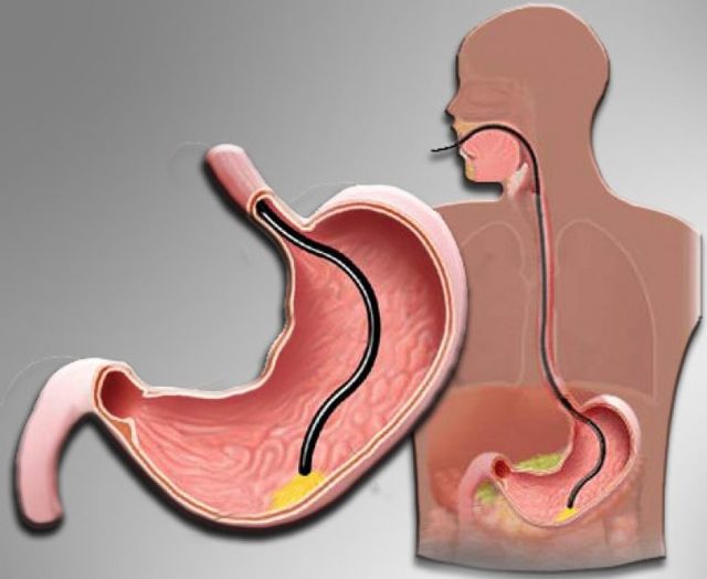 Показания и противопоказания к проведению процедуры ФГДС